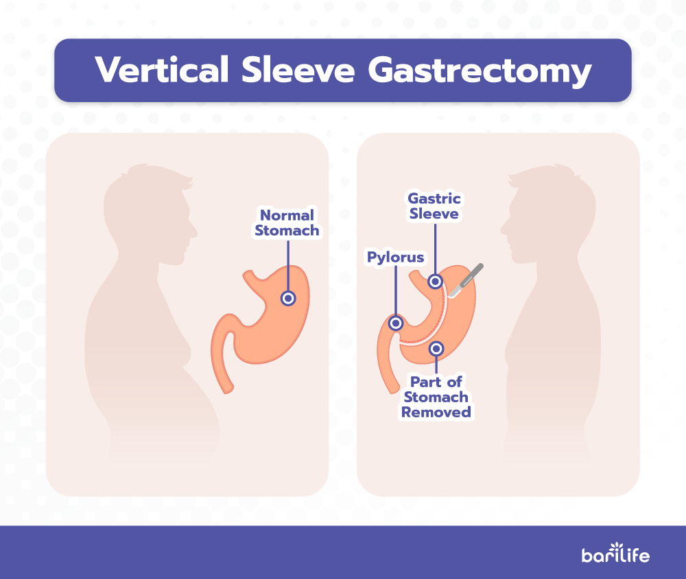 Anatomy of gastric sleeve surgery