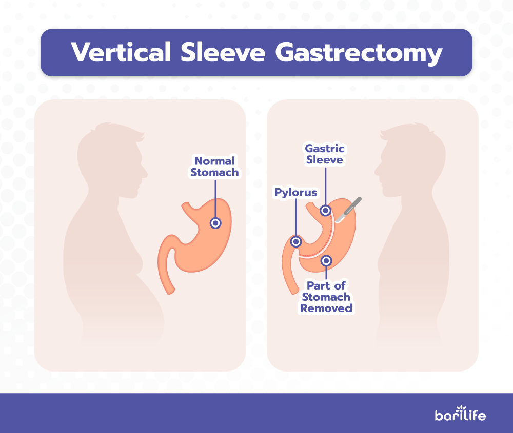 What does a gastric sleeve leak feel like? Bari Life