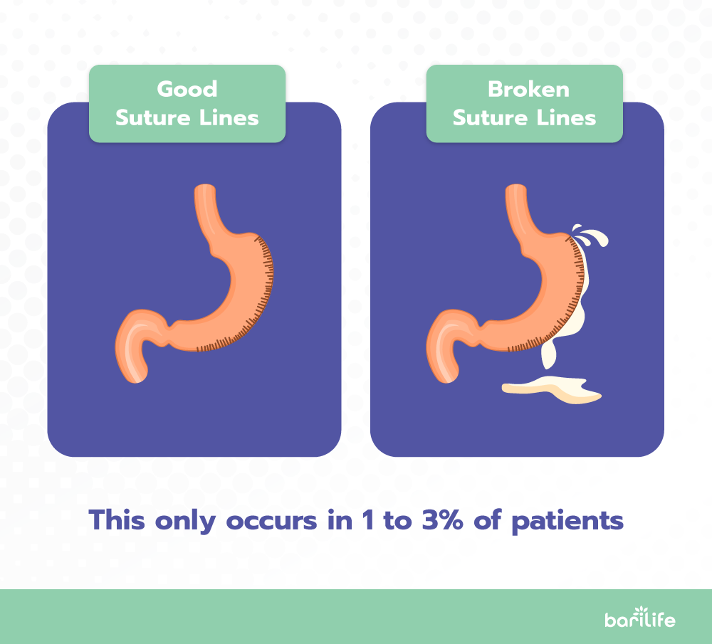 Good suture lines vs broken suture lines after gastric sleeve surgery