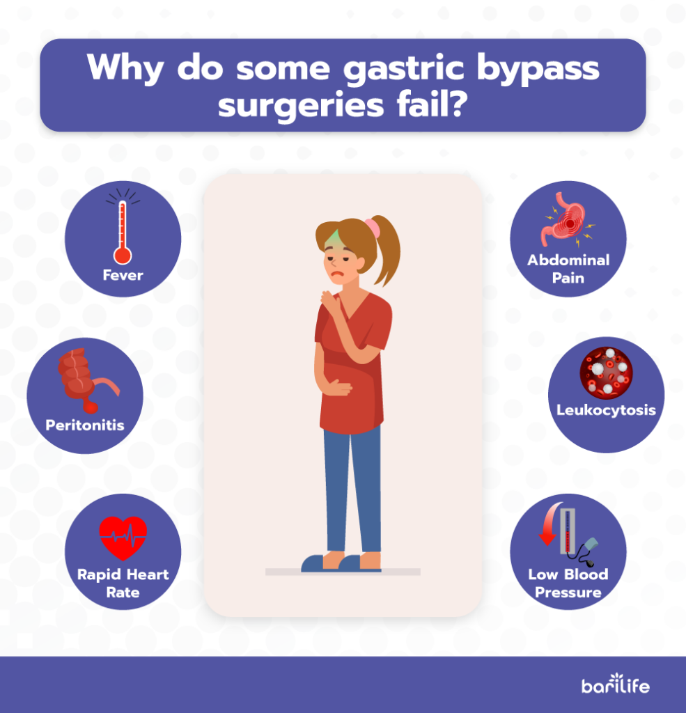 What does a gastric sleeve leak feel like? Bari Life