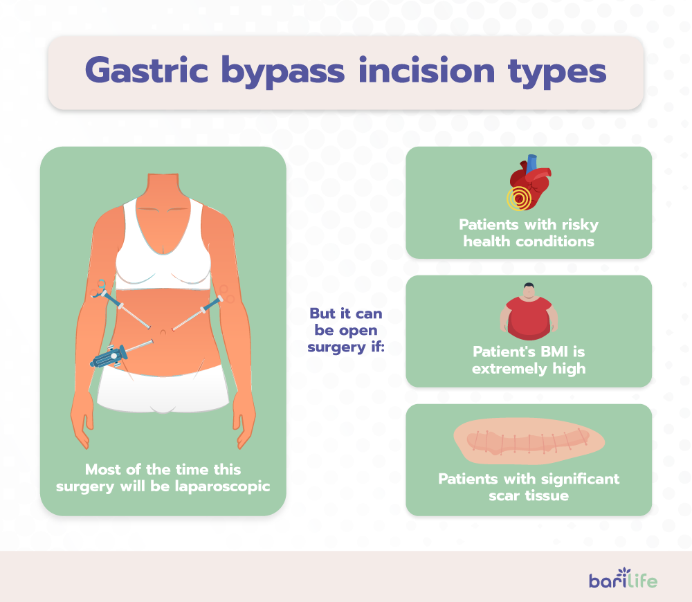 Gastric bypass incision types