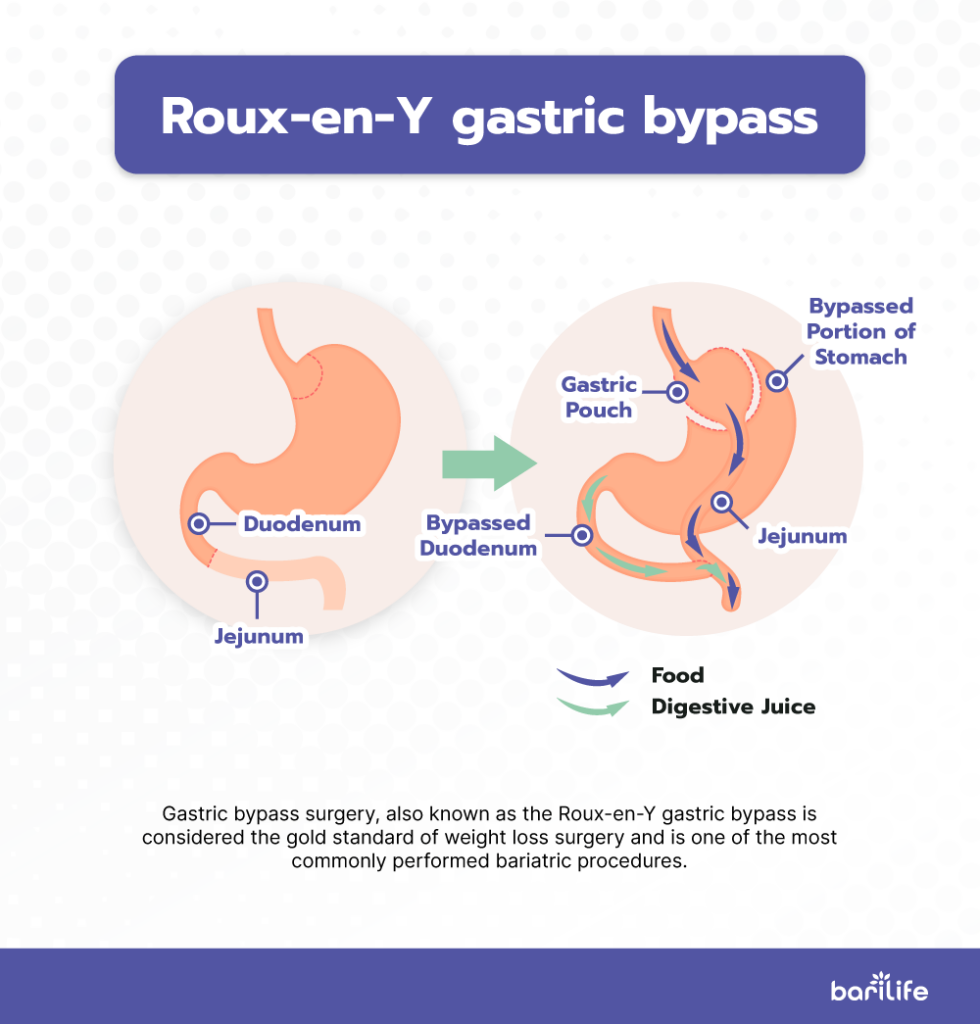 Anatomy of roux-en-y gastric bypass