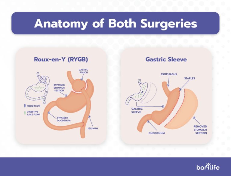 Gastric Bypass Surgery vs Vertical Sleeve Gastrectomy