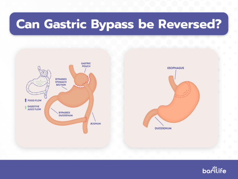Can You Reverse A Gastric Bypass?