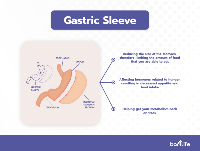What is the difference between Gastric Sleeve and Gastric Bypass?