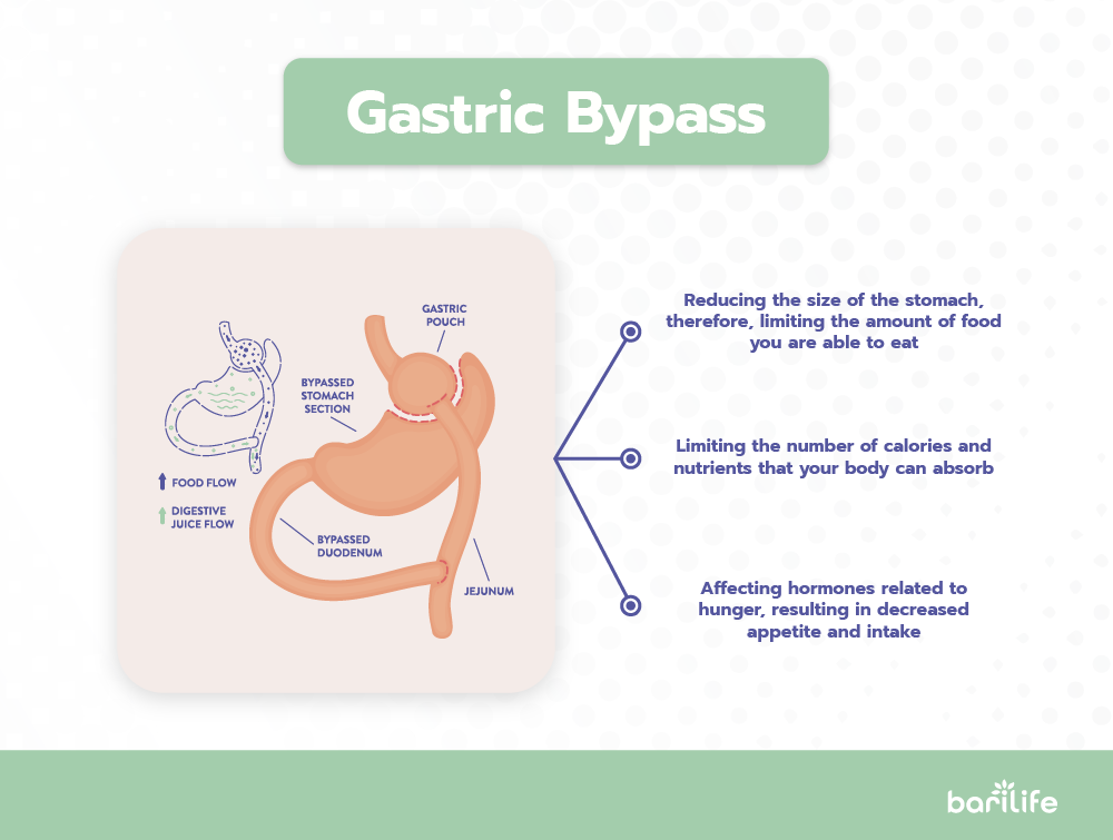 Gastric Sleeve vs Gastric Bypass: A Side-by-Side Comparison  Bari Life