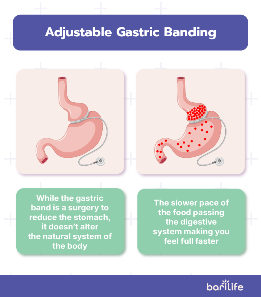 bariatric surgery types