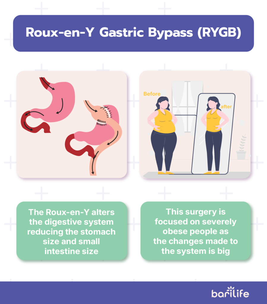 types of bariatric surgery
