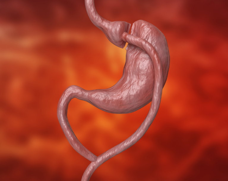 Roux en Y Bariatric Surgery: Surprising Facts