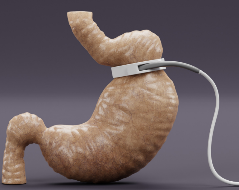 Lap Band Bariatric Surgery: 7 Essential Facts You Need to Know