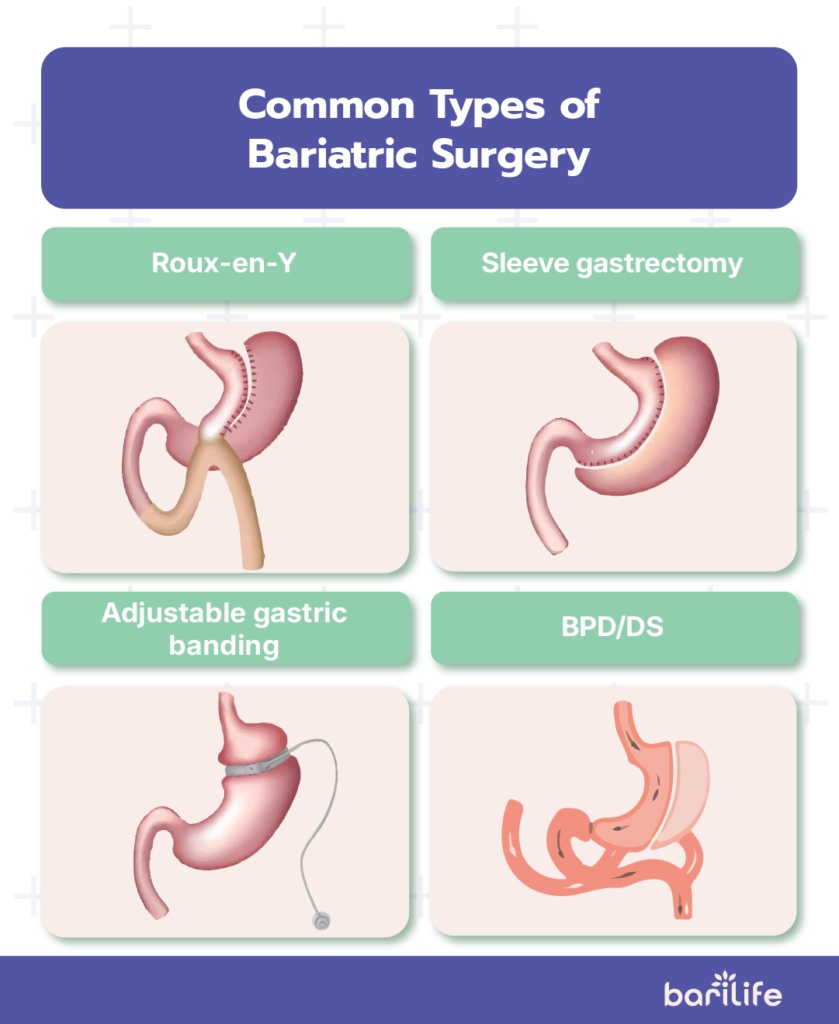 late complications of bariatric surgery