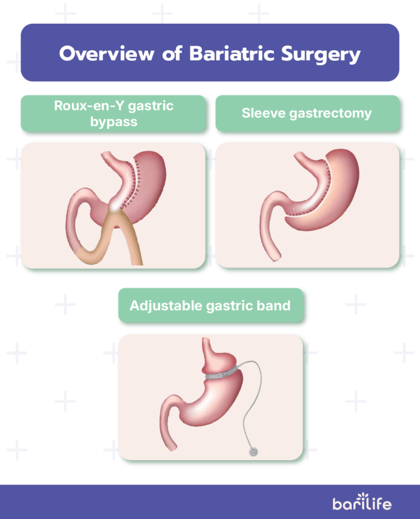 what is the most common complication of bariatric surgery