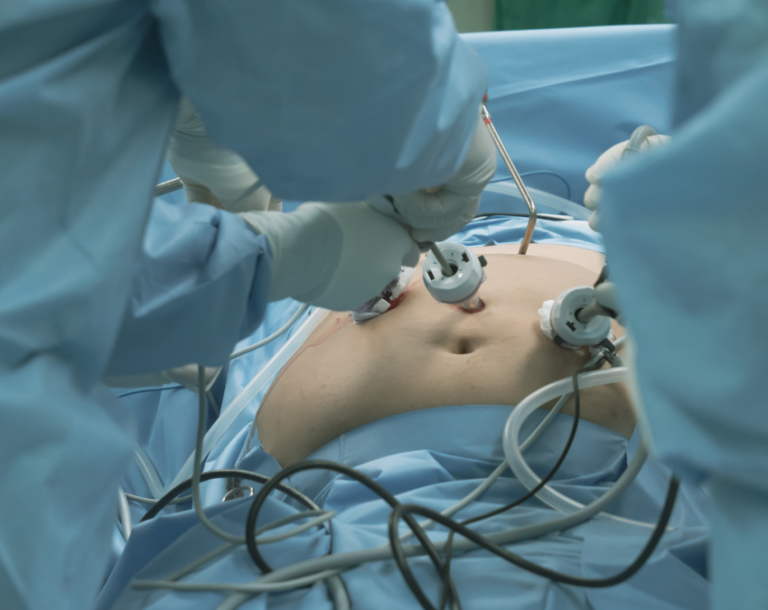 Can You Have Bariatric Surgery Twice? Read This First