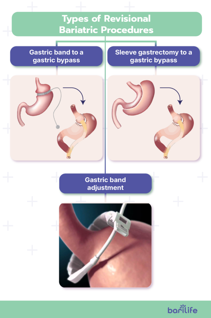can you do bariatric surgery twice