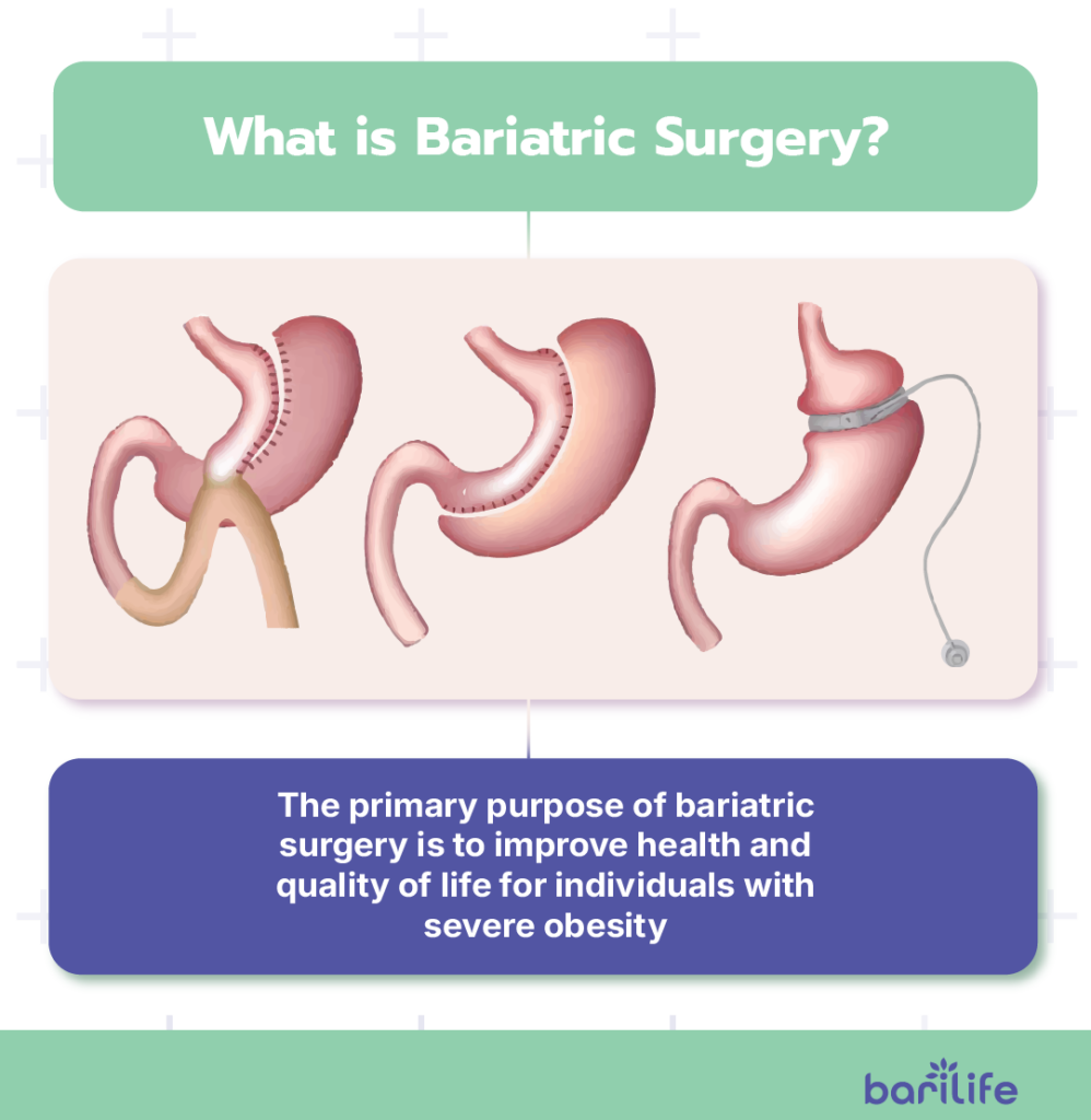benefits of bariatric surgery