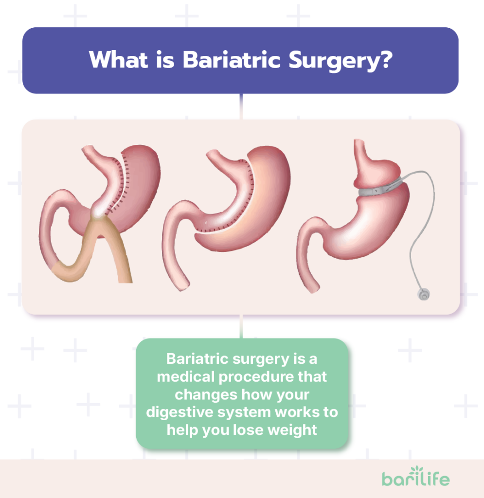 am i a candidate for bariatric surgery