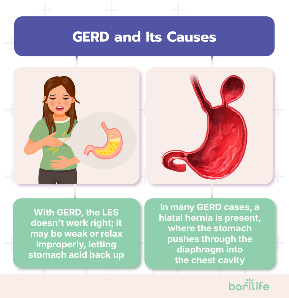bariatric surgery for gerd