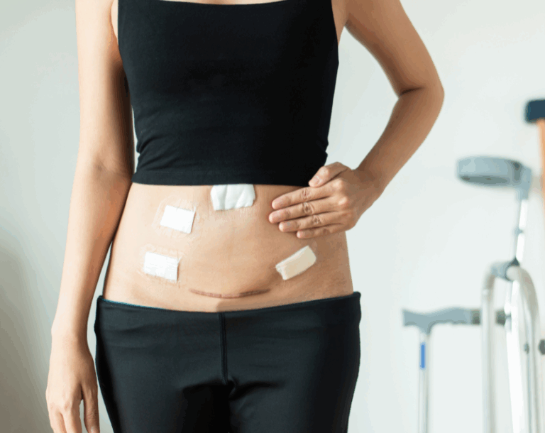 Bariatric Wound Care: What Every Patient Should Know