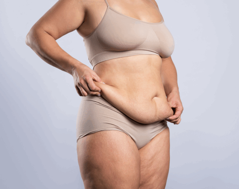 Skin Removal After Bariatric Surgery–Must-Know Facts