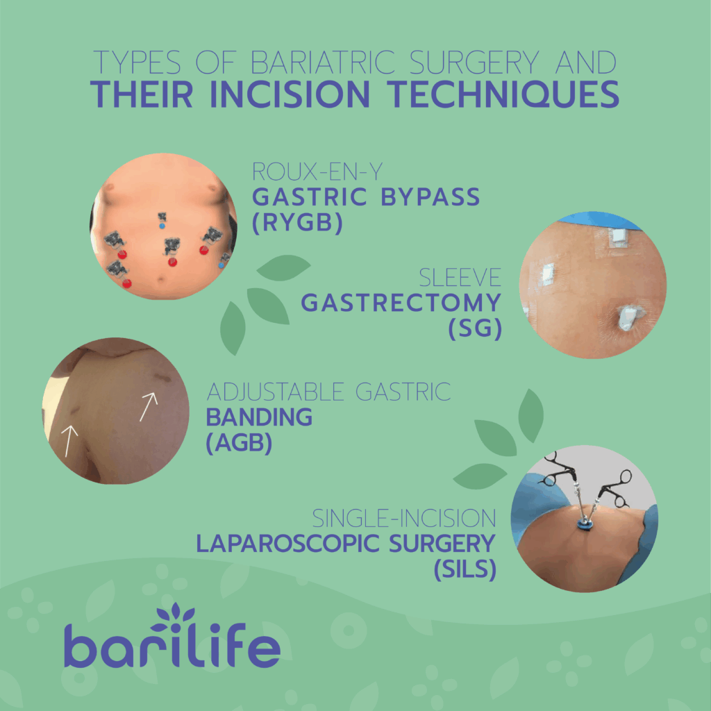 bariatric surgery incisions