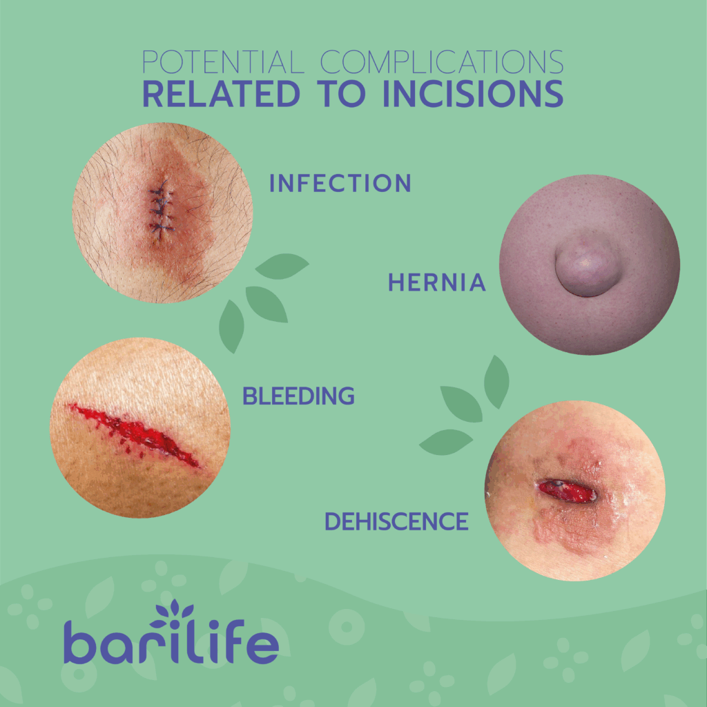 What are the 5 incisions for gastric sleeve?