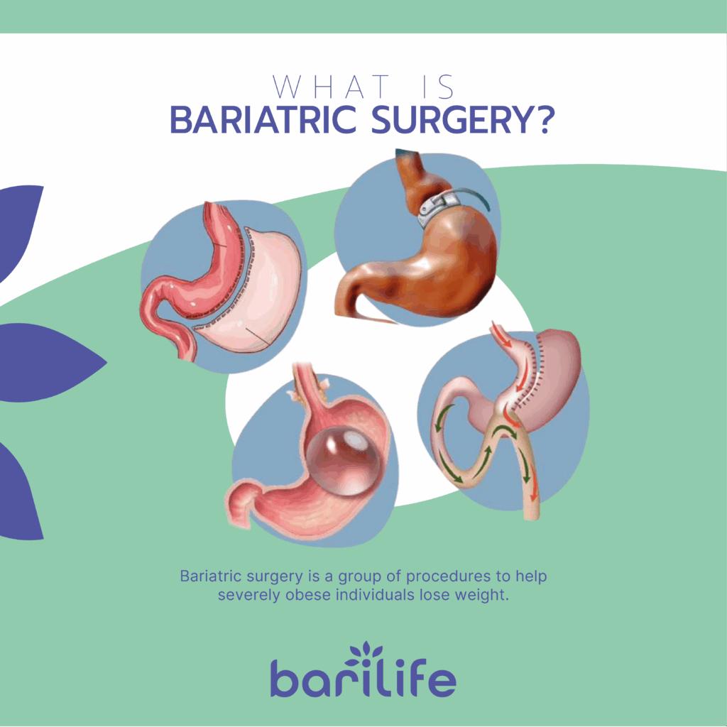 bariatric surgery pros and cons