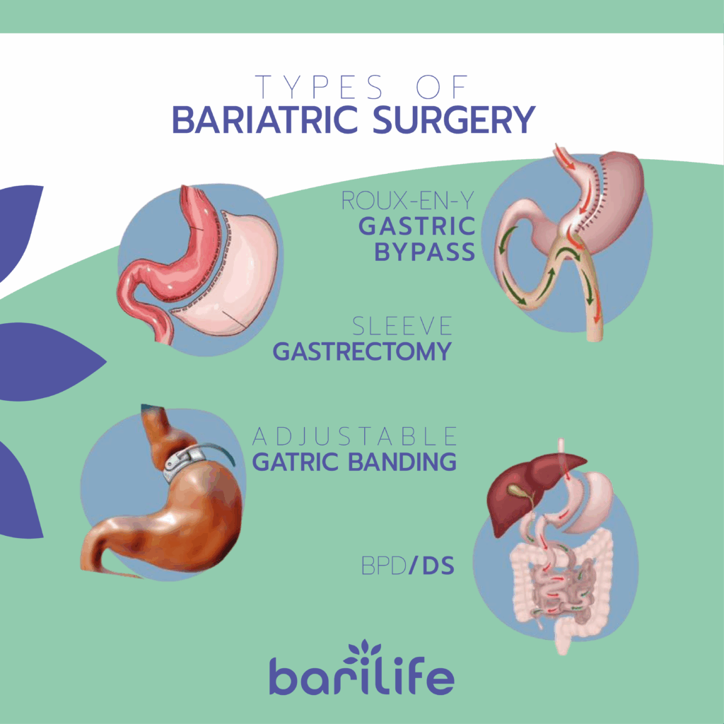 pros and cons of bariatric surgery