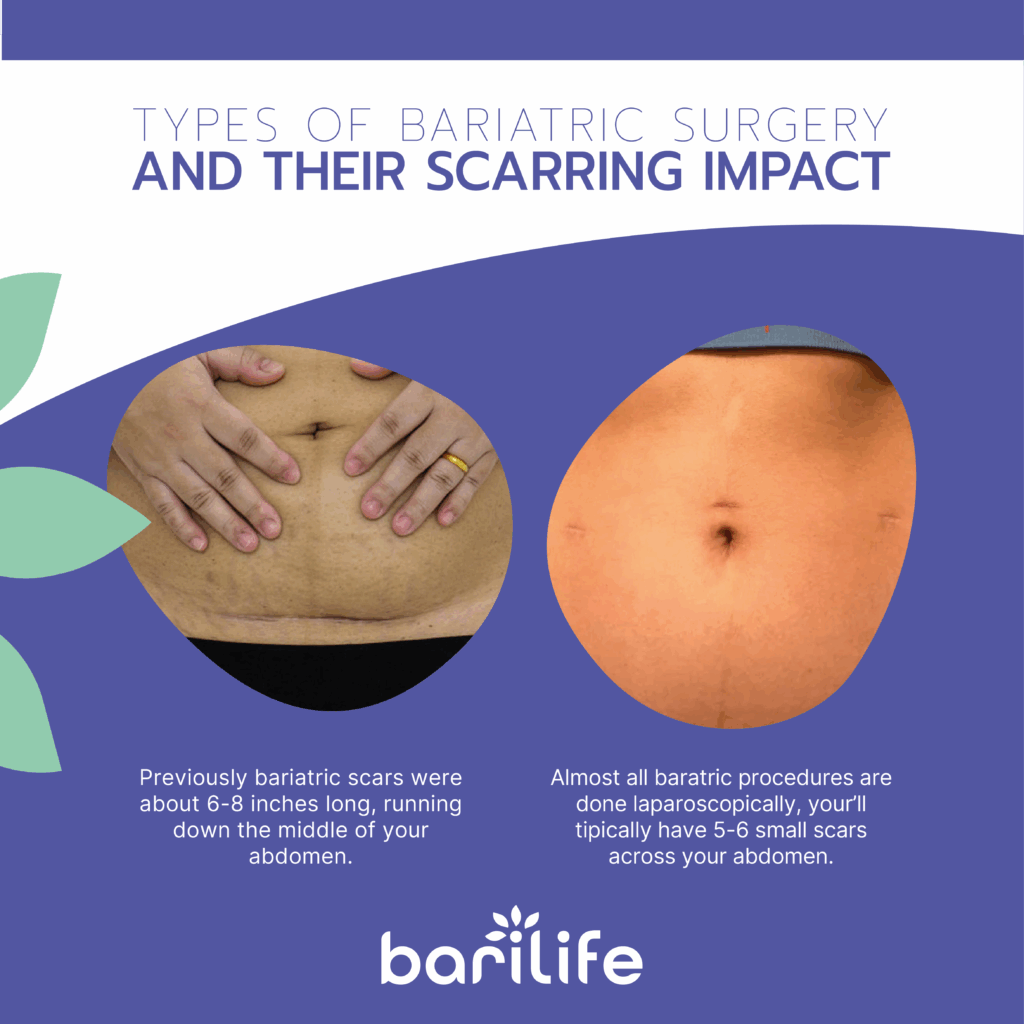 bariatric surgery scar