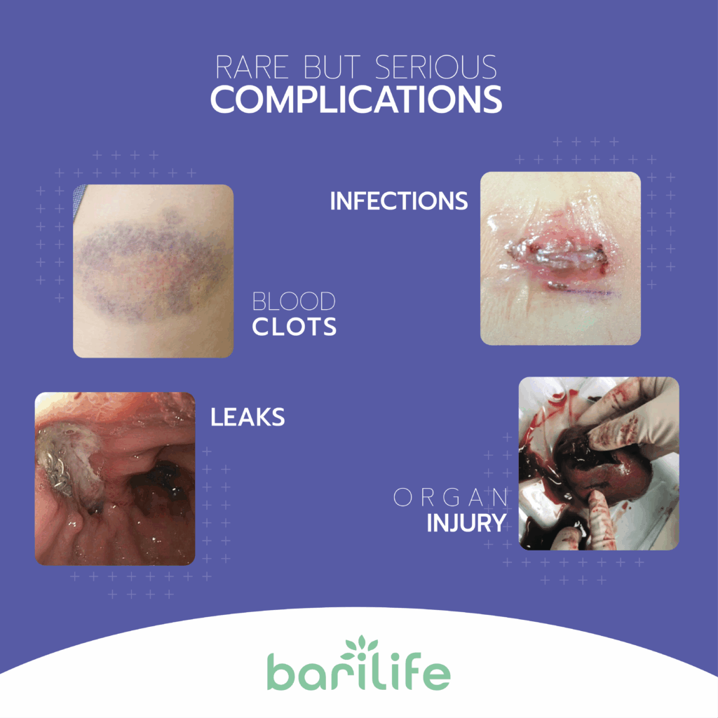 disadvantages of bariatric surgery