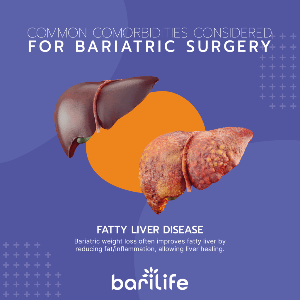 What is considered a comorbidity for weight loss medication?