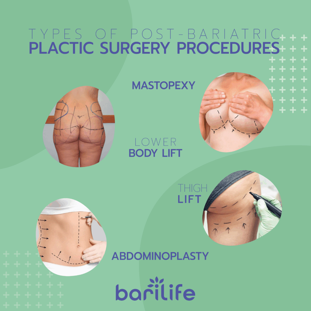 plastic surgery after bariatric surgery