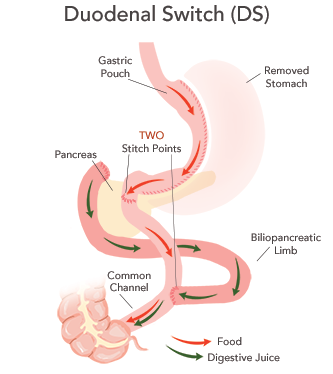 Duodenal Switch Conversion: A Viable Option When Sleeve Gastrectomy Fails Bari Life