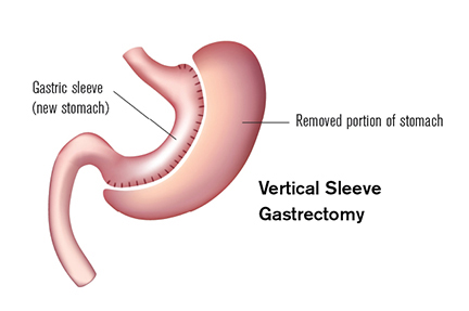 Duodenal Switch Conversion: A Viable Option When Sleeve Gastrectomy Fails Bari Life