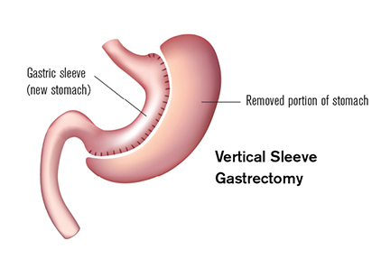 Duodenal Switch Conversion